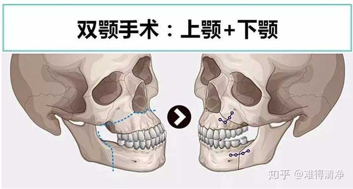 正颌手术给你的人生带来多大变化?