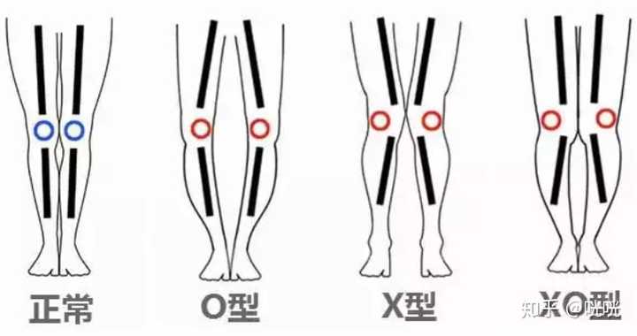 x型腿 x型腿学名叫膝外翻,就是小腿外扩.