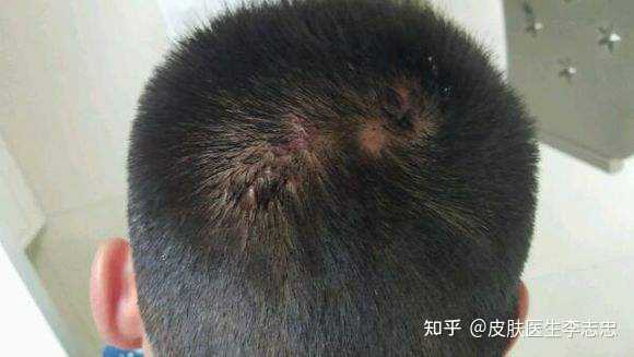 毛囊炎