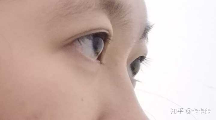 眼睛太凸怎么办?