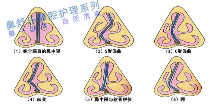 鼻中隔异常