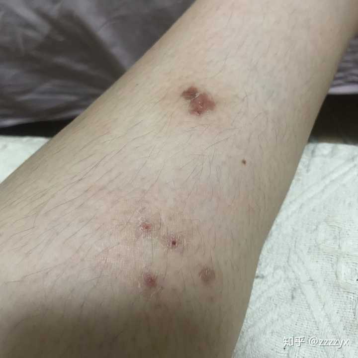 能写下你抗战荨麻疹的故事吗?