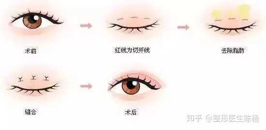 对于肉眼泡来说,做眼部抽脂安全么?
