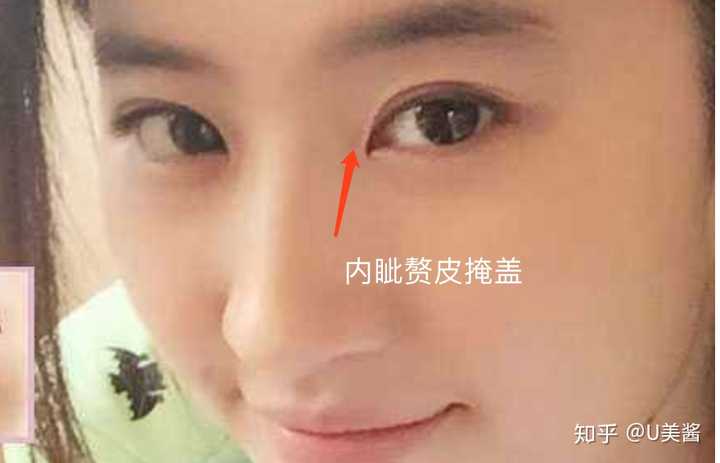 而扇形双眼皮再分细致一点就有两种形态 有内眦赘皮的,代表眼,刘亦菲