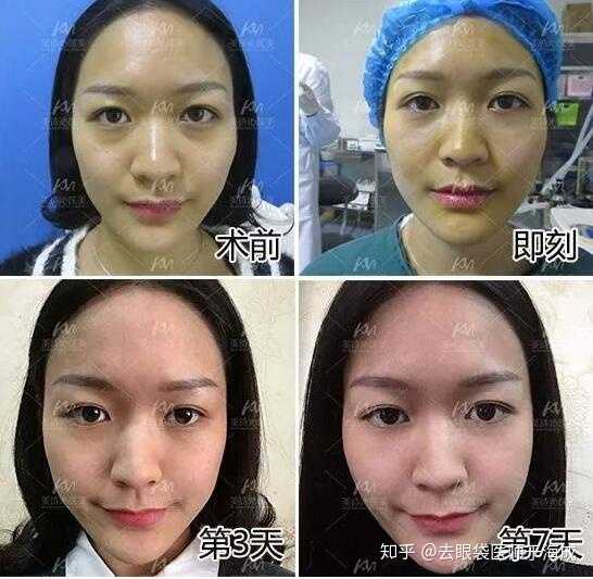 去眼袋是注射复合多肽和复合蛋白好,还是微创开刀去眼袋方式好?