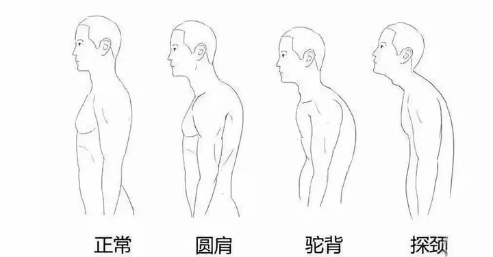 不睡枕头真的能改善驼背吗