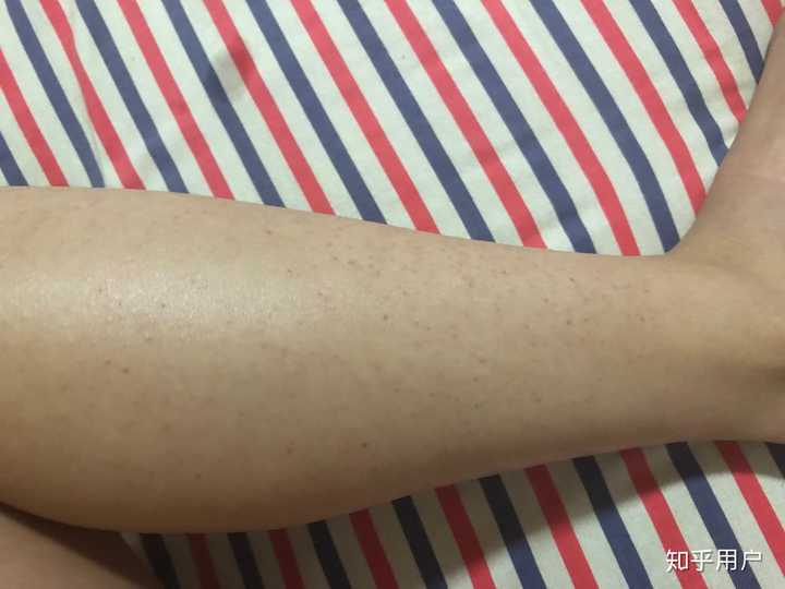 右小腿一直比左边要严重很多,但是对比上次的可以看见色素有改善了!