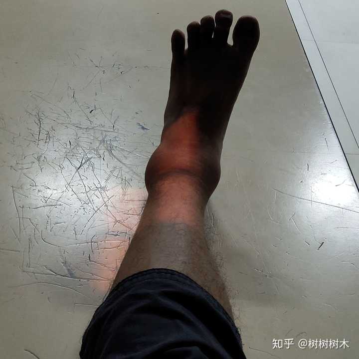 崴脚第7天,拍x光现场