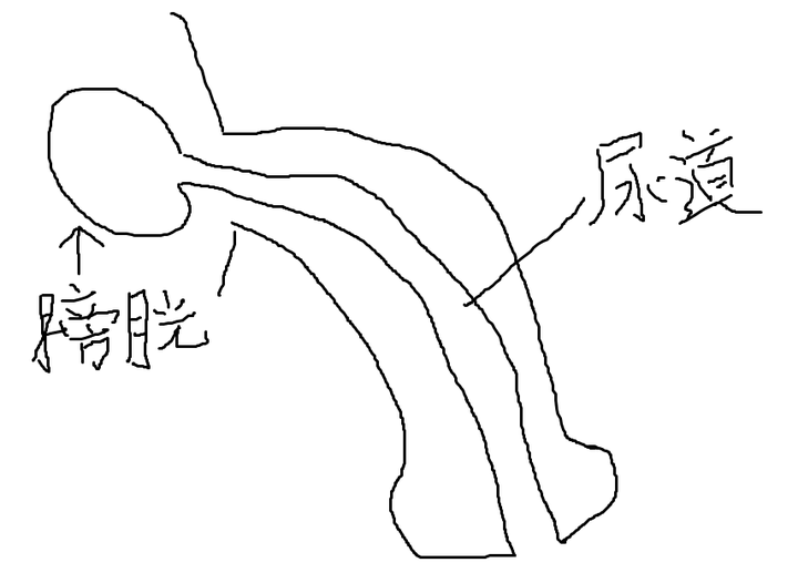 勃起后尿道宽度变窄