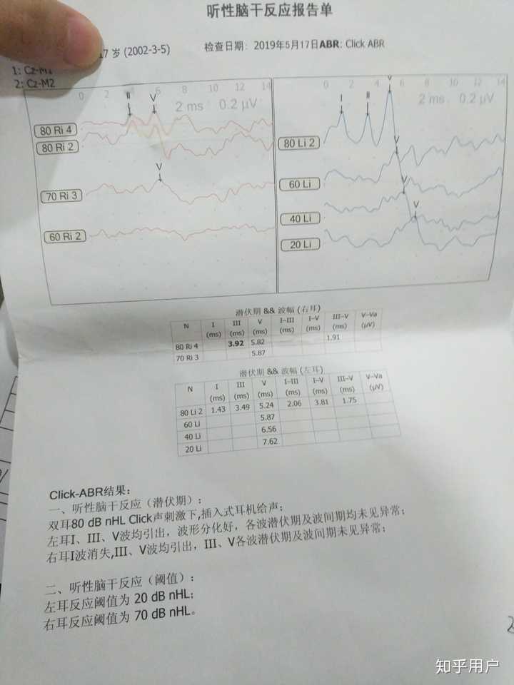 感音神经性耳聋.23岁,右耳听力完全丧失,左耳轻度听损.