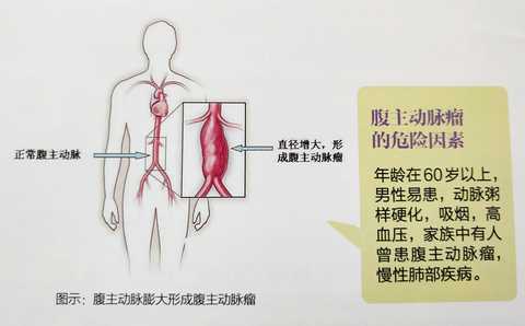 腹主动脉瘤是指腹主动脉局限性的扩张,形成直径超过3cm以上的膨大.