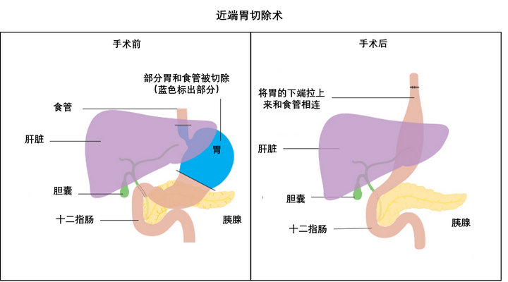 3,全胃切除术