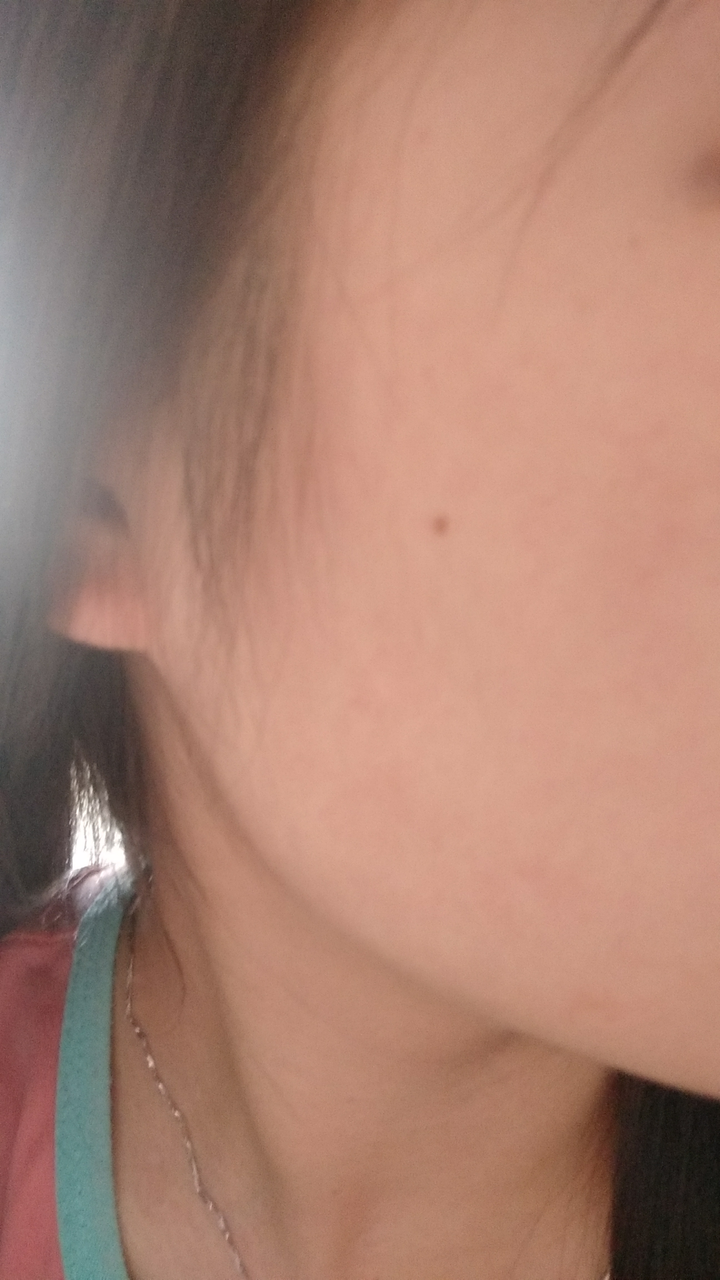 点痣后留下的红坑要多久才能恢复?