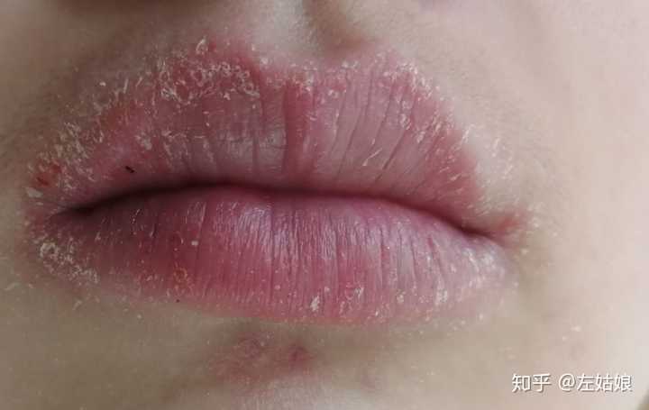 唇炎到底是一种什么病呢?