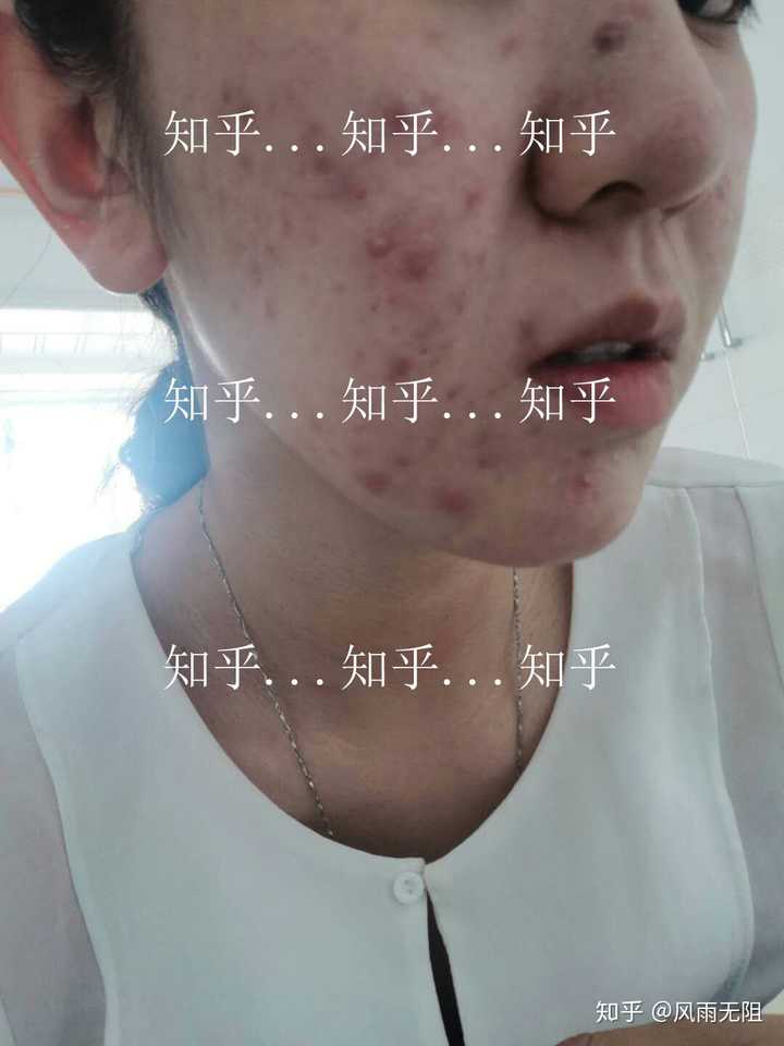 只有右脸颊起痘痘,开始是硬硬的,然后冒出带脓白头的痘,反复起!