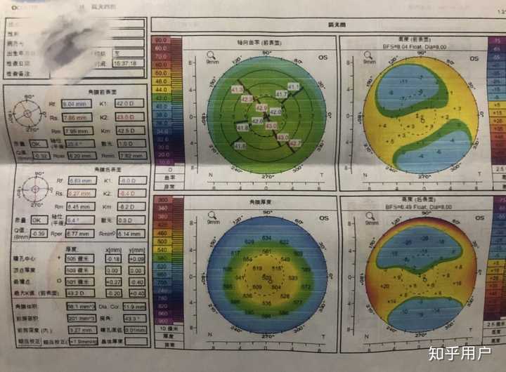 角膜地形图分析?