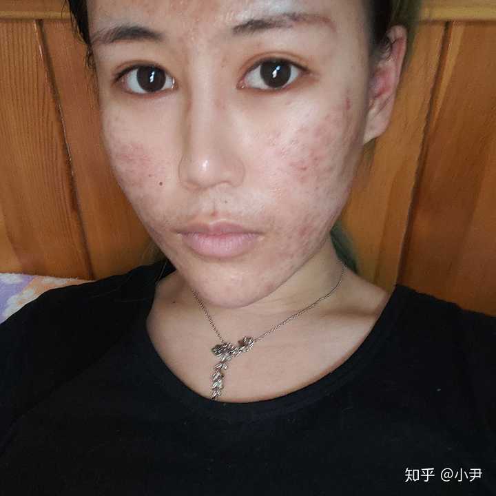 男生是不是不会喜欢脸上有痘印或痘痘的女孩子啊?