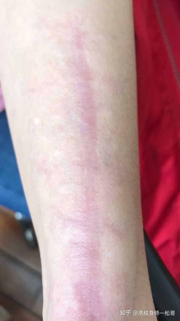 有洗纹身不留疤成功的案例吗?
