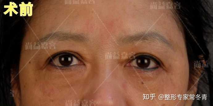 有一种说法"年轻时双眼皮好看,上了年纪单眼皮好看"正确么?