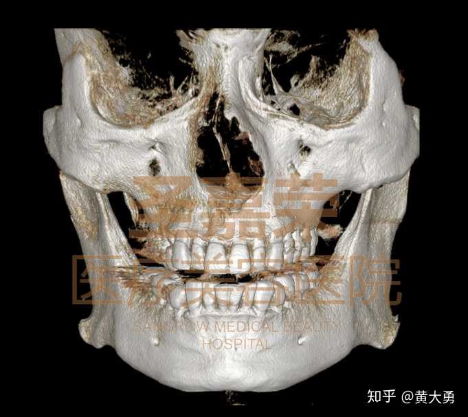 面部削骨能让一个人变化多大?