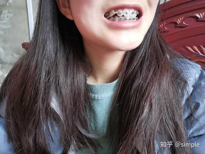 女孩子带牙套会很丑嘛