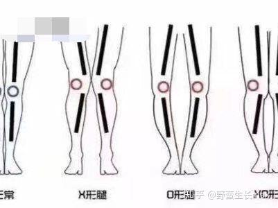 请问表面看上去膝盖并不拢,小腿中间也有缝是o型腿,但是腿使劲并拢