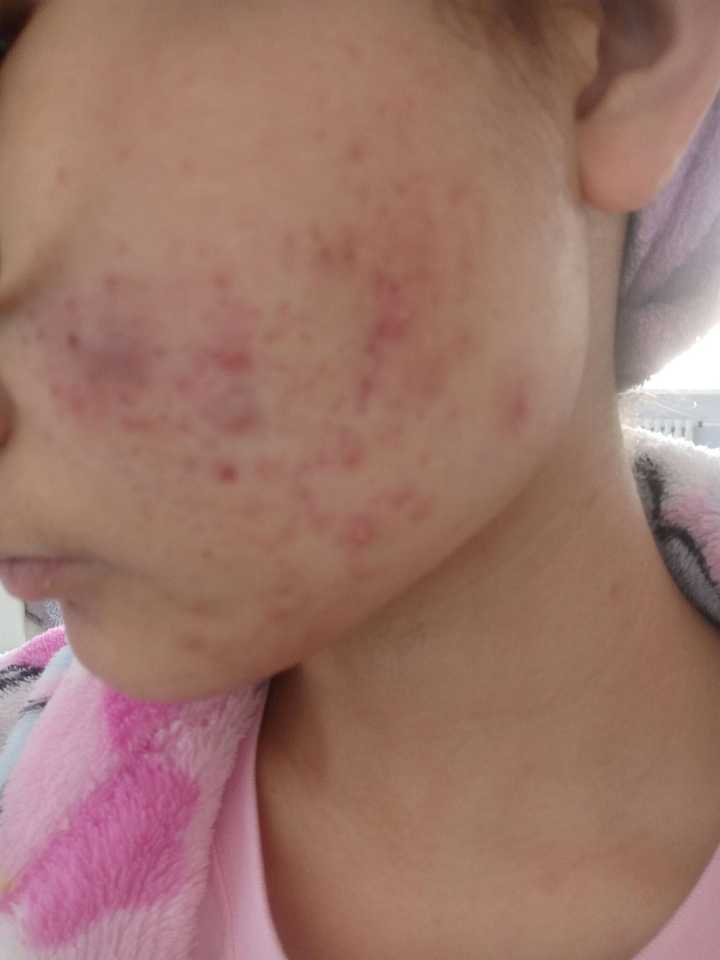皮肤差痘坑多的女生会有男生喜欢吗?