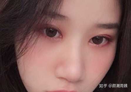 单眼皮可以变双眼皮吗?