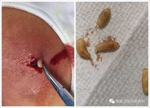 蝇蛆病是指蝇类的幼虫----蛆寄生在人体或动物体上引起的疾病.