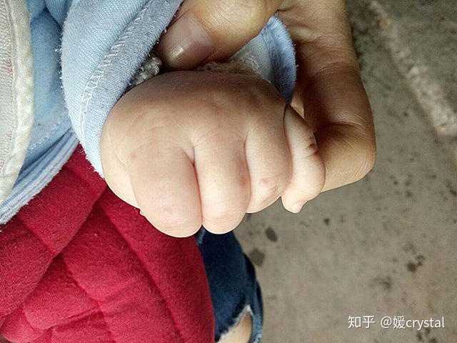 孩子手指长倒刺是什么原因?