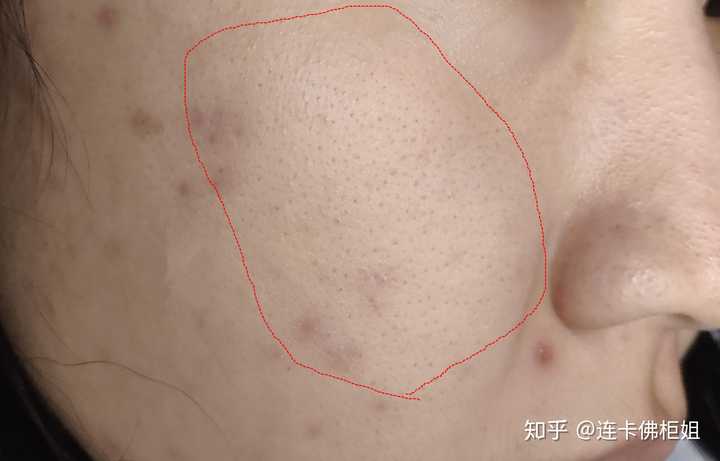 如何解决面颊毛孔粗大?