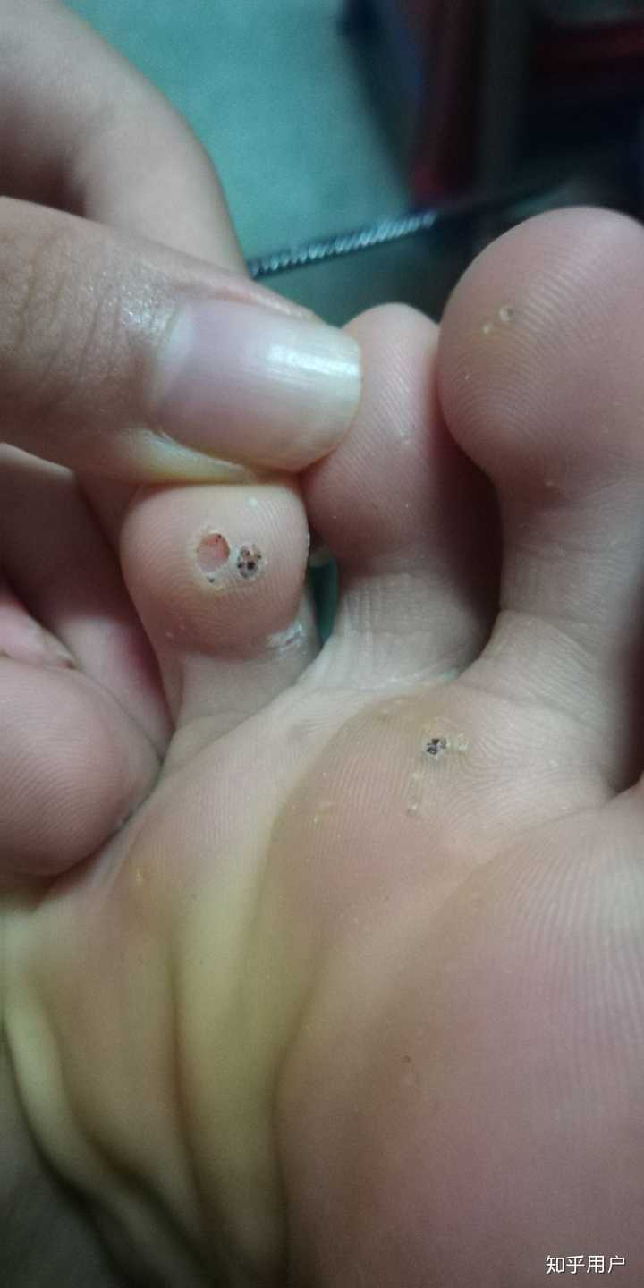 治疗跖疣的好方法,不影响日常生活?