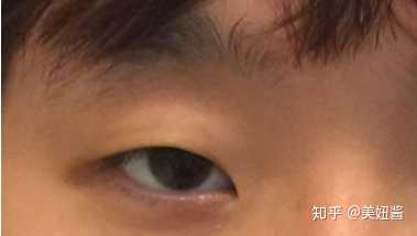 眼裂太短就是我们说的绿豆眼,这样的眼睛如果只割双眼皮,不开眼角,看
