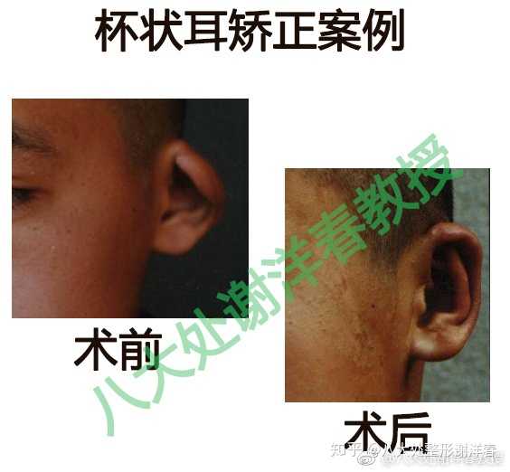 【案例】杯状耳矫正前后对比,孩子很听话,很内向,做完以后很开心