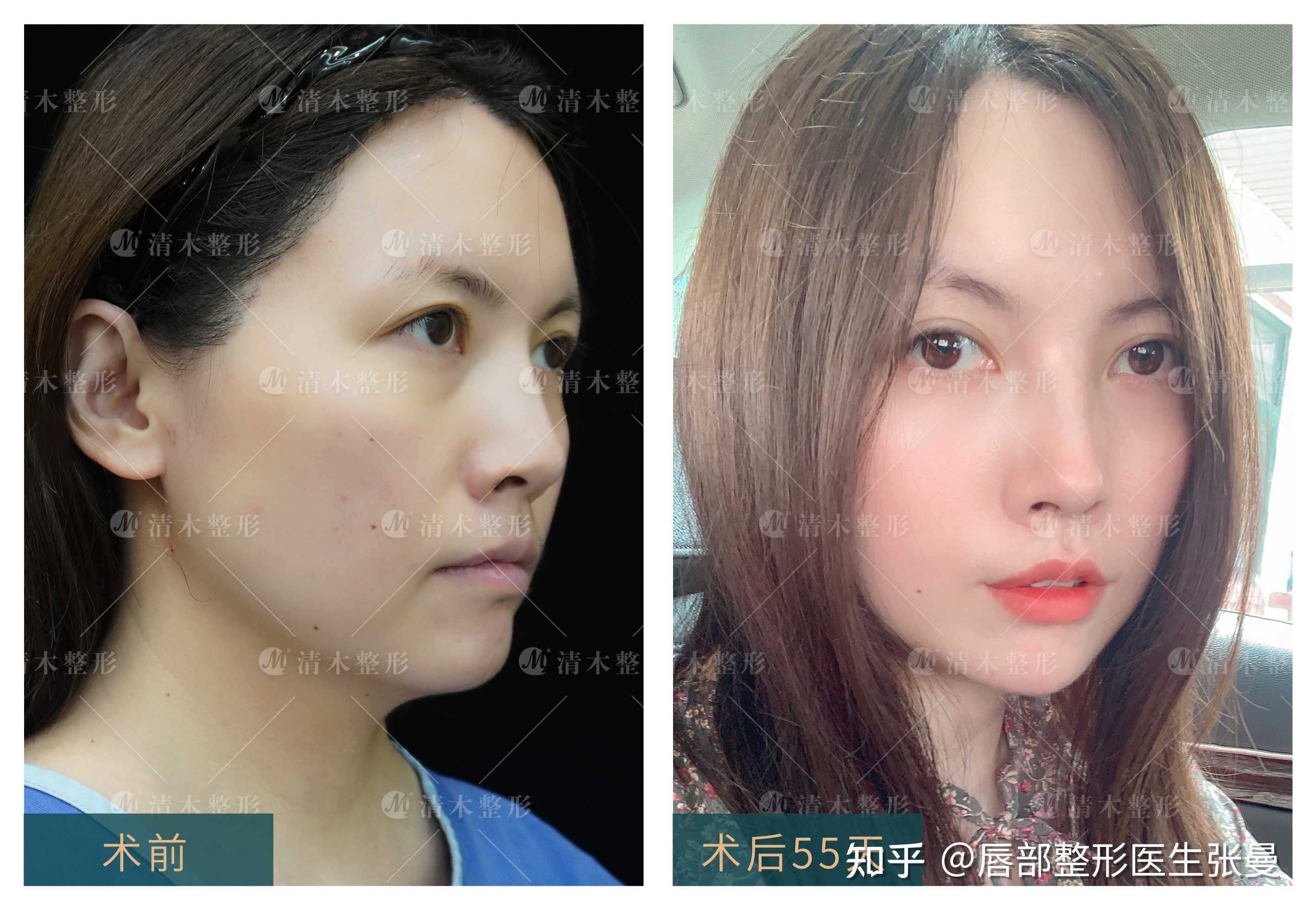嘴角上扬玻尿酸丰唇
