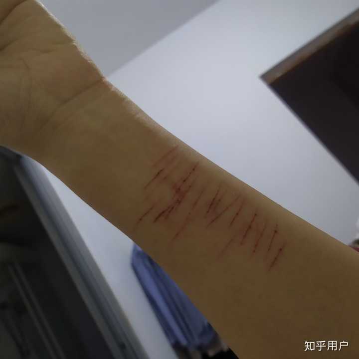我知道它又来了,眼泪止不住 双手开始发抖 连拿刀片划手的时候一点
