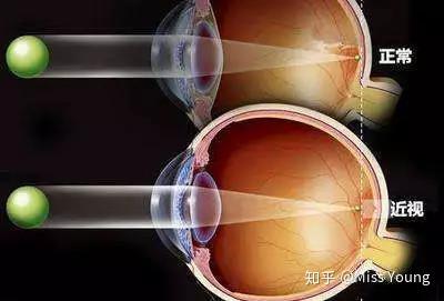 近视眼如何恢复视力摘掉眼镜?