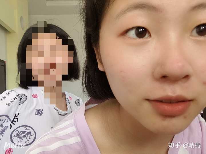 内双 肿眼泡是什么样的感觉?