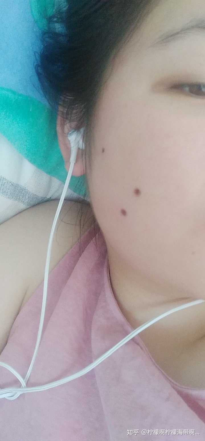 夏天点痣应注意事项?