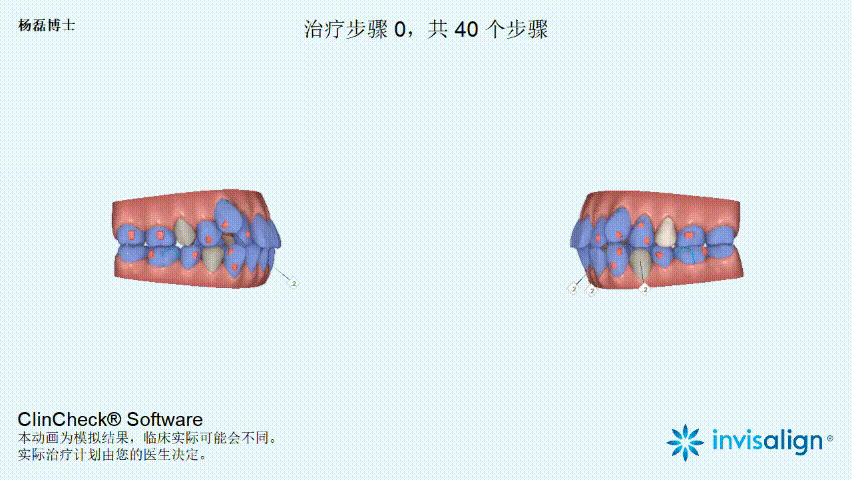 牙齿矫正杨磊博士 的想法: #北京牙齿矫正# #隐适美