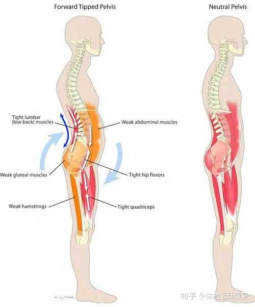 骨盆前倾,髂腰肌到底处于一种什么样的状态?