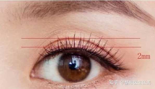 做7毫米的双眼皮宽度是大多数追求自然双眼皮效果姑娘所做的宽度 像