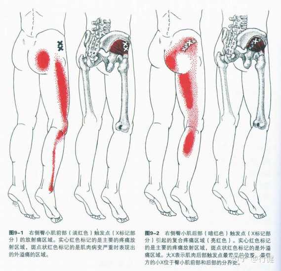 臀小肌(引发假性坐骨神经痛) 以上需要特别注意的是臀小肌,因为一旦