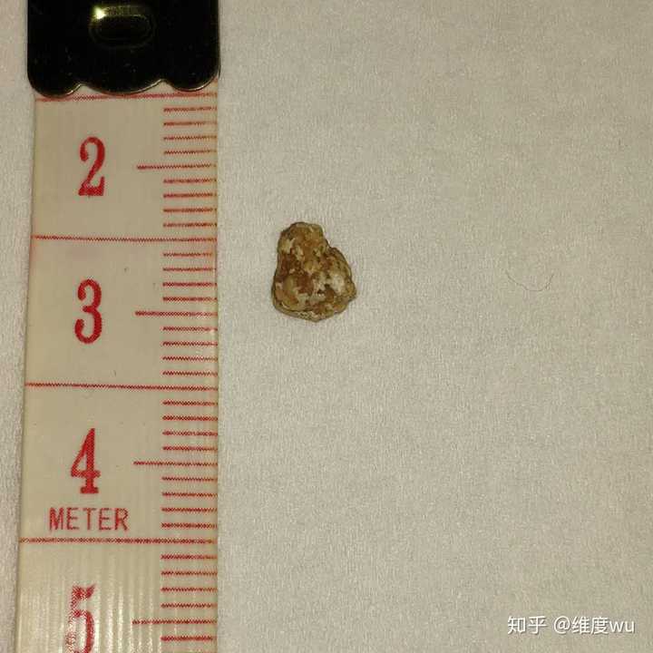 0.7的肾结石能自己排下来吗?