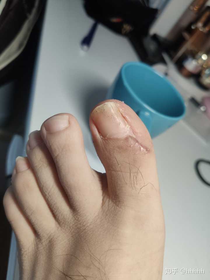 你们的甲沟炎最后都是怎么治好的