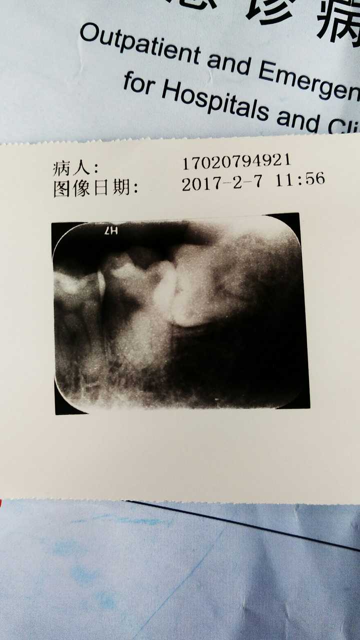 拔一颗这样的智齿真的要花费800块吗?