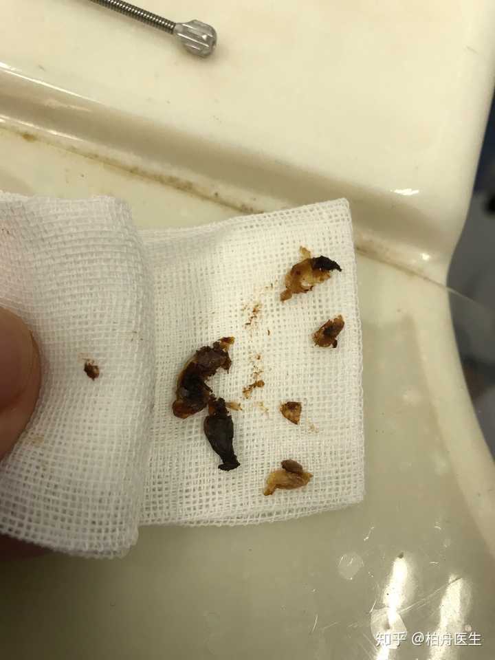 耵聍栓塞是什么 知乎