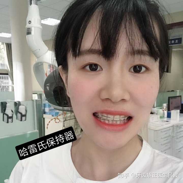 戴上保持器的她,哈雷氏保持器