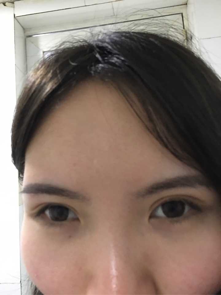 全切双眼皮两个多月了还是肿?