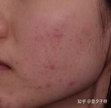 皮肤在什么情况下需要刷酸,有哪些注意事项?